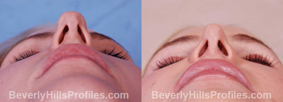 Female nose, before and after Rhinoplasty treatment, underside view (narrow nostrils)