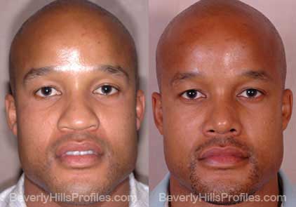 Male face, before and after African American Rhinoplasty treatment, front view - patient 3