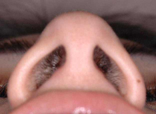 Female nose, underside view (narrow nostrils)