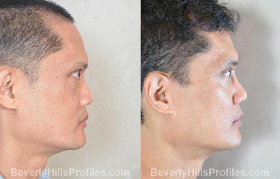 rhinoplasty before and after flat nose