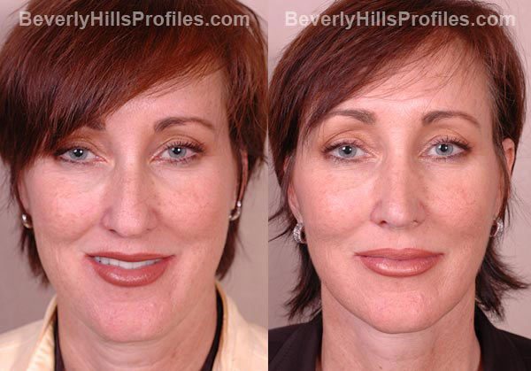 Facial Fat Transfer Before & After Photos