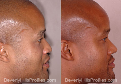 Male face, before and after African American Rhinoplasty treatment, r-side view - patient 3