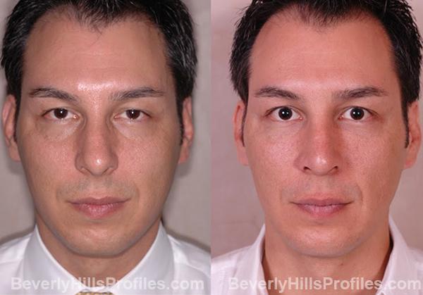 forehead implants before and after