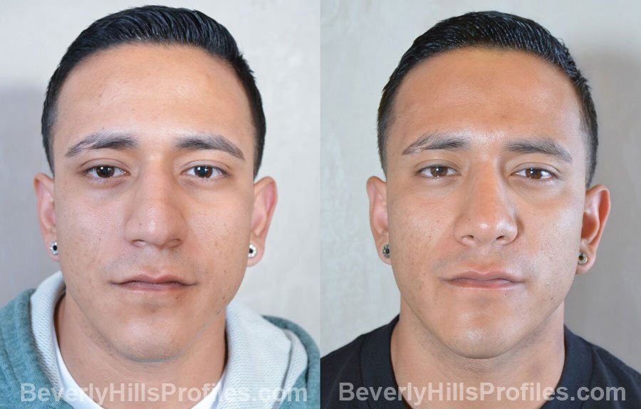 Rhinoplasty 67