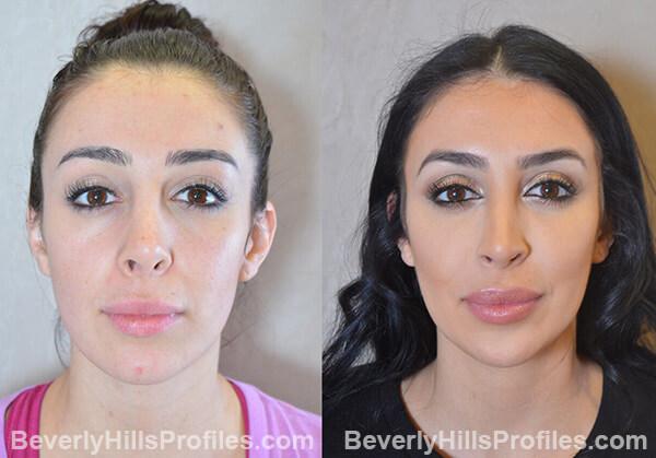 Revision Rhinoplasty Before & After Photos, Beverly Hills | LA Rhinoplasty
