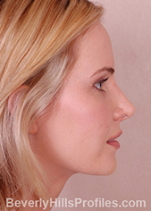 Finesse Rhinoplasty | Subtle Nose Job Surgery