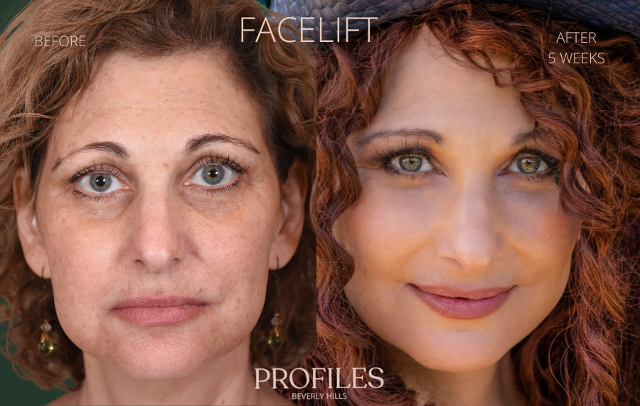 Full Face Contouring Before & After Photo Gallery